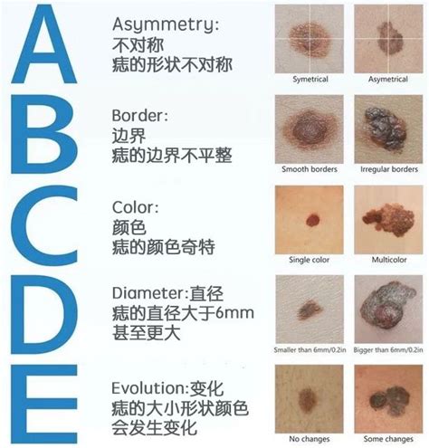 痣 顏色|痣有4種顏色，出現在「手腳這邊」的痣可能是皮膚癌！「ABCDE。